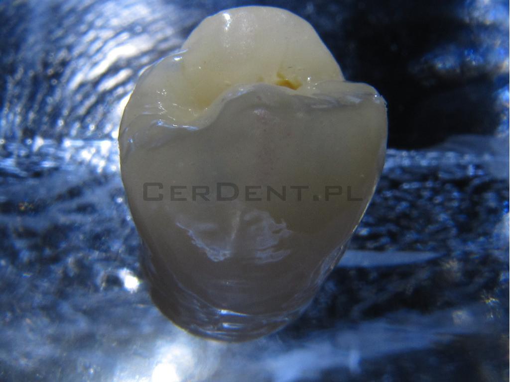 Korona Ceramiczna Porcelanowa Cyrkonie Implanty CAD/CAM