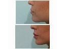 Powiększanie i konturowanie ust