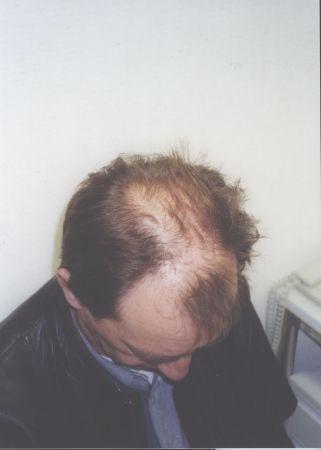 Transplantacje włosów-leczenie łysienia W-wa, Warszawa, mazowieckie