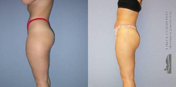 LIPOSUCTION Profesjonalnie Pewnie POLECAMY!!, Warszawa, mazowieckie