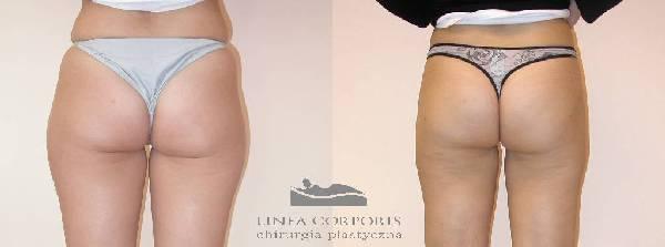 LIPOSUCTION Profesjonalnie Pewnie POLECAMY!!, Warszawa, mazowieckie