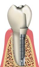 Implant