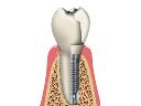 Implanty stomatologiczne  -  Blue Dental