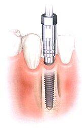 Implant etap 2