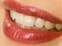 Wybielanie zębów  -  Blue Dental