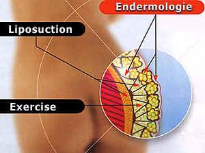 Endermologia-modelowanie sylwetki po ciąży. AXIS, Poznań, wielkopolskie