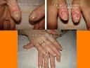 Rekonstrukcja długotrwale uszkadzanych paznokci