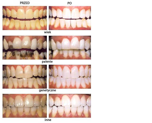 Wybielanie zębów - 299 zł, POZNAŃ, wielkopolskie