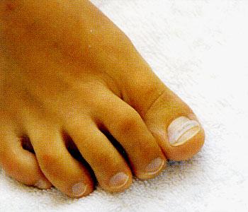 Pedicure medyczny-wrastające paznokcie sosnowiec, śląskie