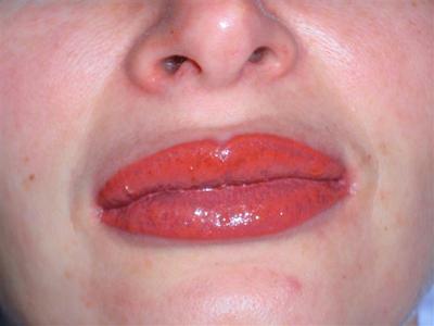 efekt tuż po zabiegu, usta uprzednio powiększone botoxem - usta kontur z wypełnieniem kolorem - kliknij, aby powiększyć