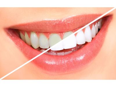 Kosmetyczne wybielanie zębów - kliknij, aby powiększyć