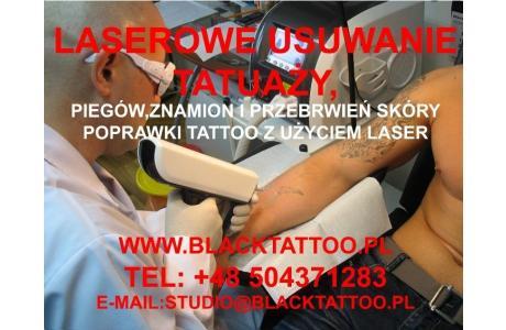 Laserowe usuwanie tatuaży piegów znamion itp, Warszawa, mazowieckie