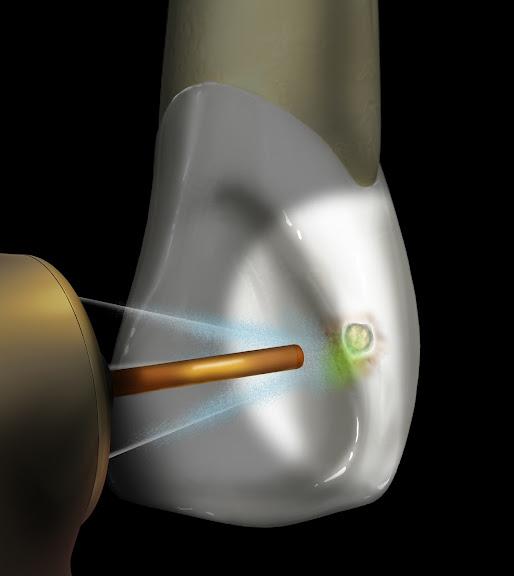 Łagodne światło lasera gwarancją precyzyjnego zabiegu
