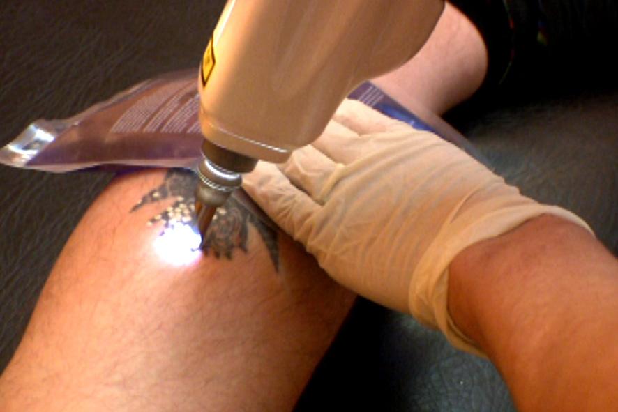 laserowe usuwanie tatuażu usuwanie.com