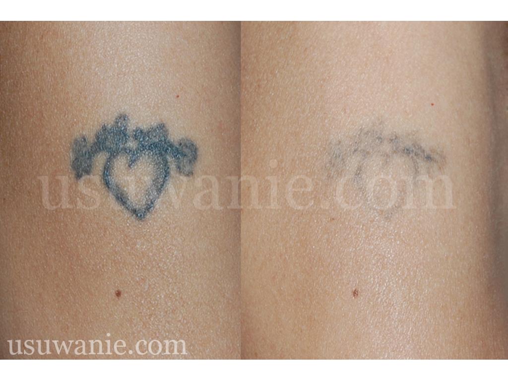 laserowe usuwanie tatuażu, efekt po dwóch zabiegach