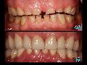 Korony porcelanowe - rekonstrukcja protetyczna zębów