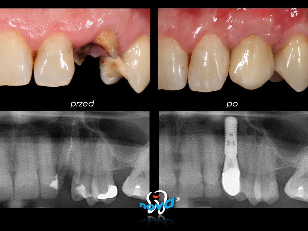 Implant Straumann + korona pełnoceramiczna