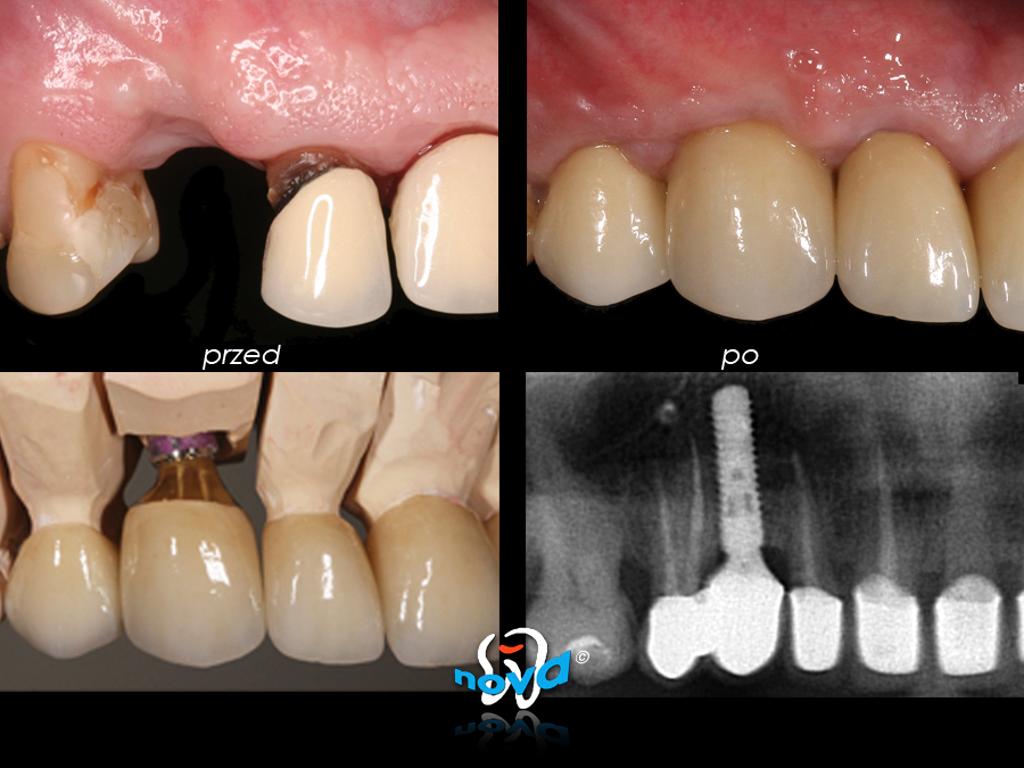 Implant Straumann + korona porcelanowa LAVA