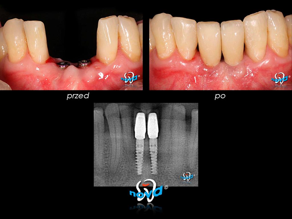 Odbudowa siekaczy dolnych - implanty Nobel Active