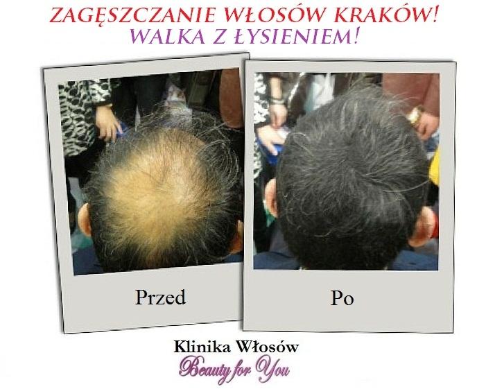 Łysienie, uzupełnianie włosów, wypadanie włosów, Kraków, małopolskie