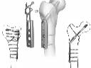 Orthopedic Implants Manufacturers & Suppliers