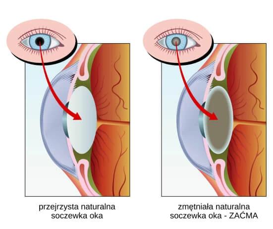 Nowoczesna diagnostyka i metody leczenia Zaćmy / Katarakty, Bielsko-Biała, śląskie