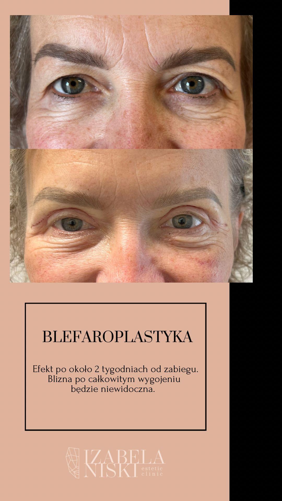 Blefaroplastyka - Chirurgiczne Podnoszenie Powiek Górnych