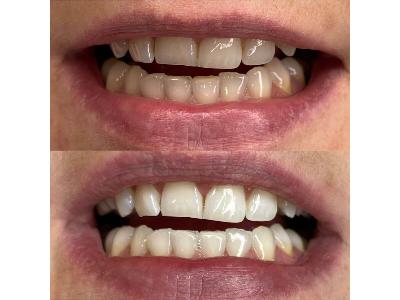 Efekt kosmetycznego wybielania zębów - kliknij, aby powiększyć