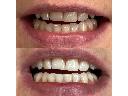 Efekt kosmetycznego wybielania zębów