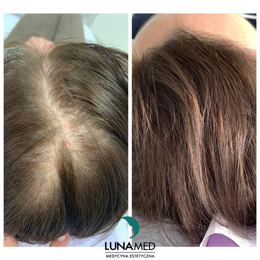 efekty leczenia wypadanie włosów, łysienie - Lunamed