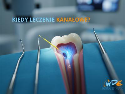 Leczenie kanałowe - kliknij, aby powiększyć