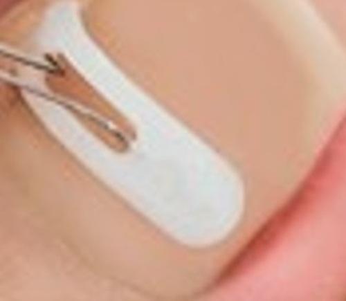 leczenie wrastających paznokci